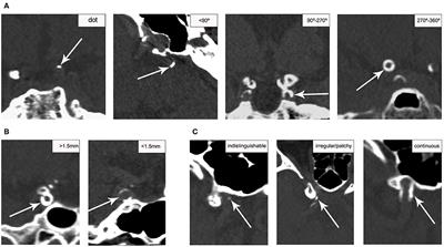 Understanding the Clinical Implications of Intracranial Arterial Calcification Using Brain CT and Vessel Wall Imaging